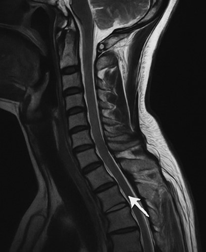 spine injury illustration